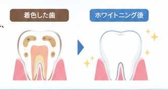 ホワイトニングとは